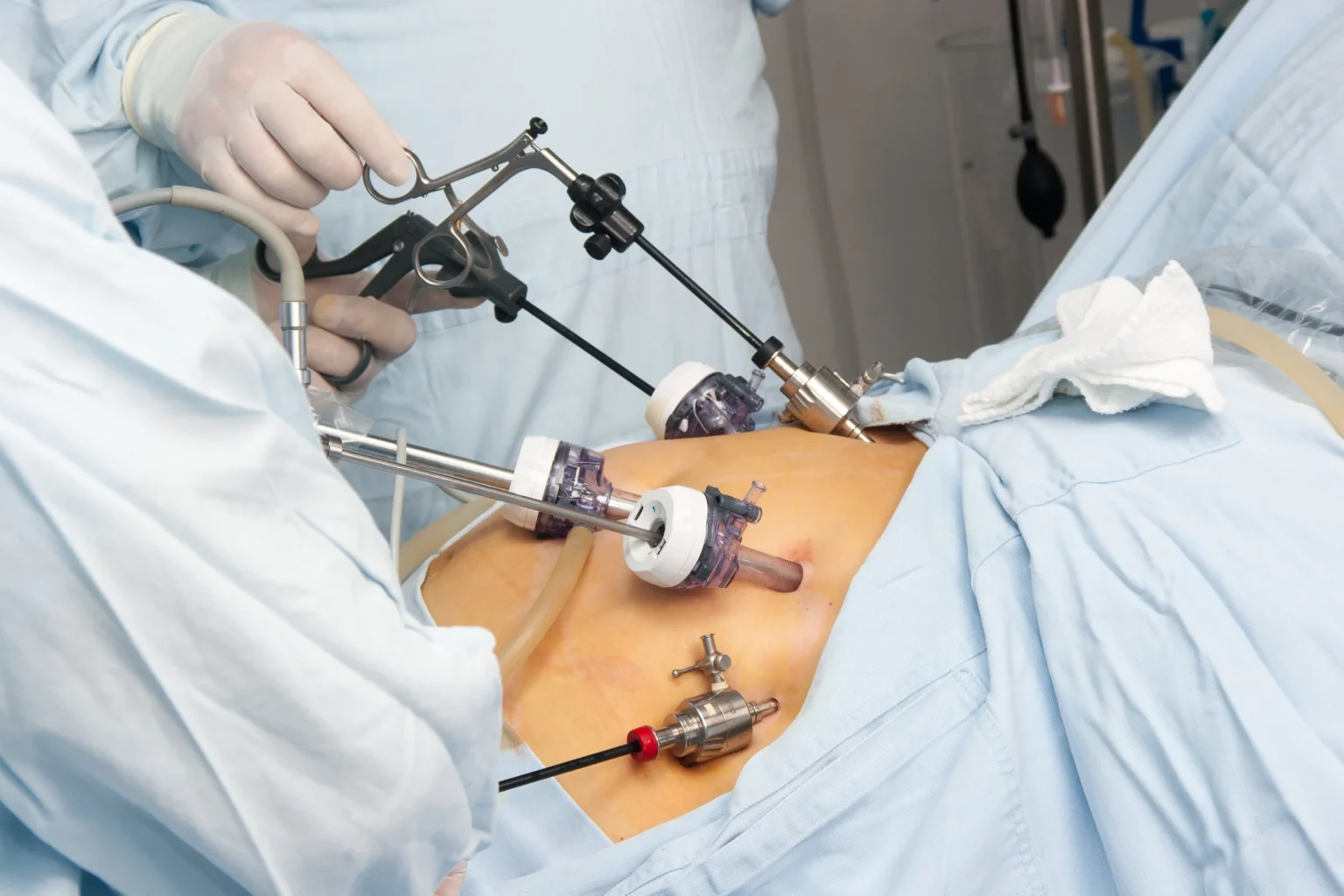 Gallbladder Removal