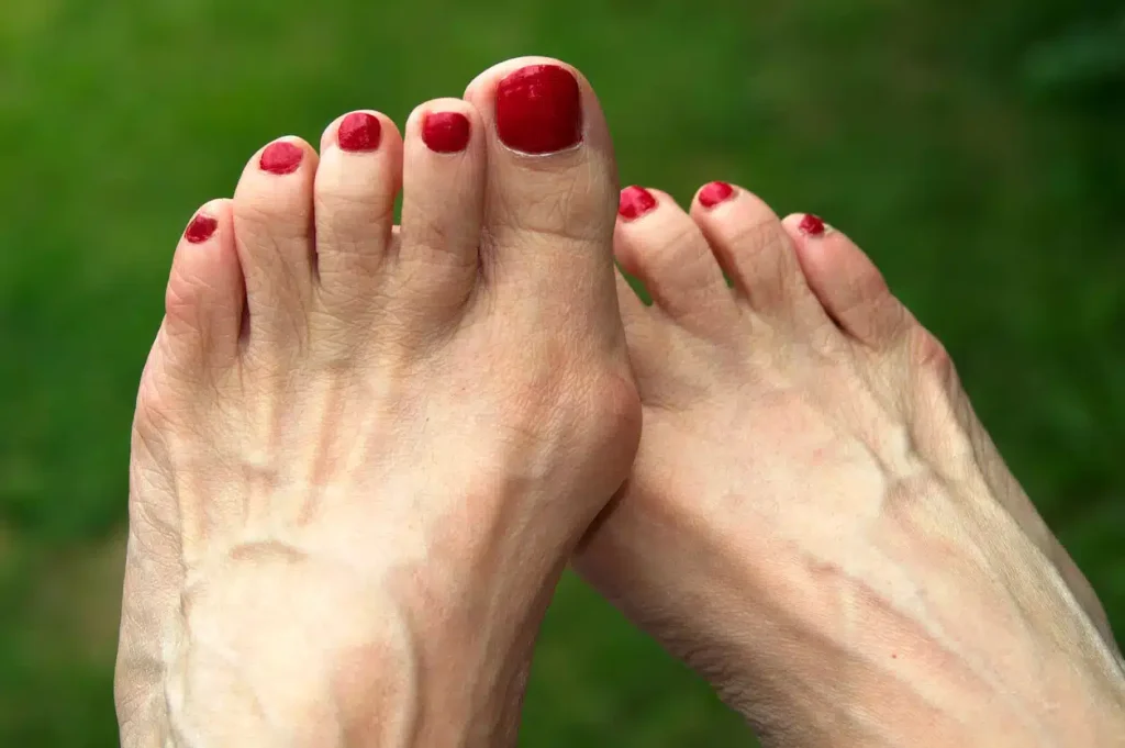 Alleviate Bunions