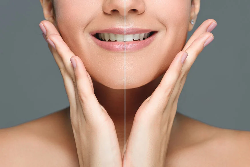 Teeth Whitening at Home vs. Professional Treatments Professional