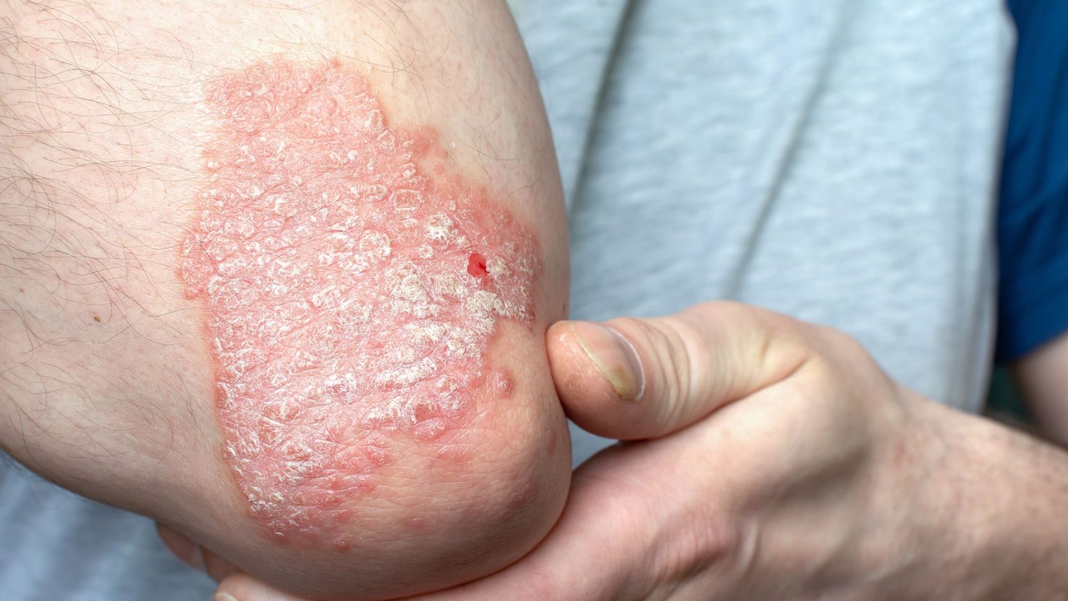 Recognizing Symptoms of Psoriatic Arthritis and Seeking Effective Treatment Symptoms of Psoriatic Arthritis