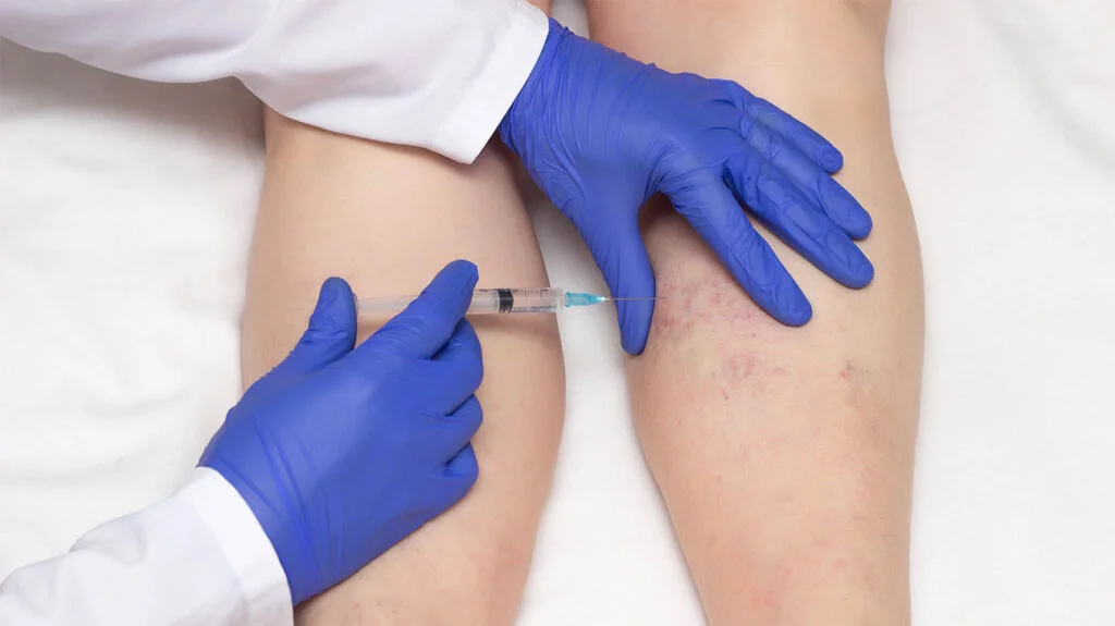 Signs It May Be Time for a Vein Treatment Vein Treatment