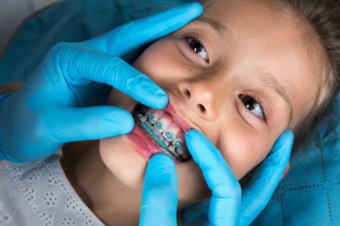 Braces for Kids and When Is the Right Time to Start? Braces for Kids