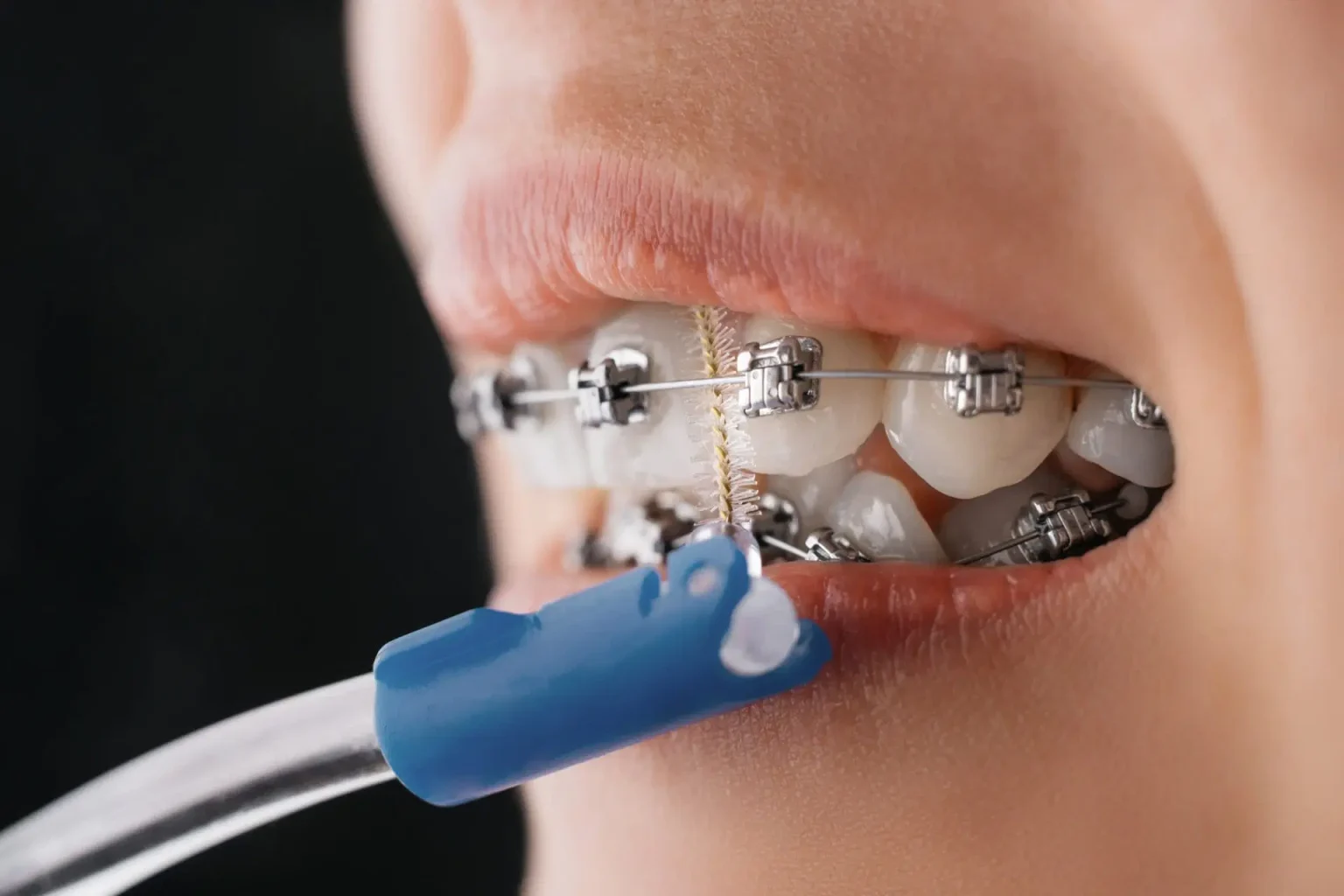 Care for Your Braces