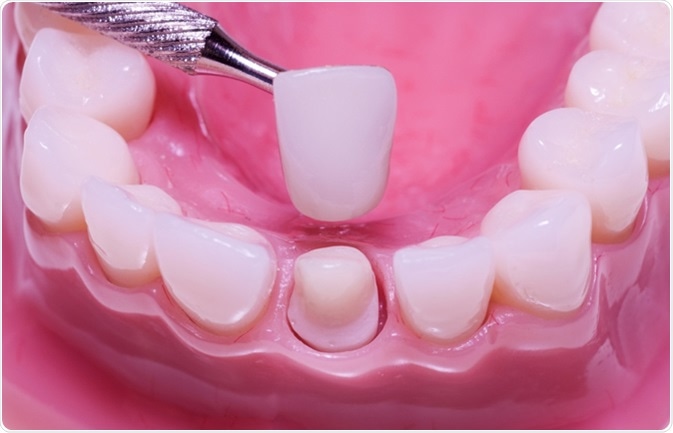 The Process of Getting Dental Crowns Dental Crowns