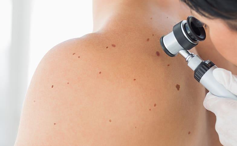 Signs and Symptoms To Watch for When Dealing With Skin Cancer Skin Cancer