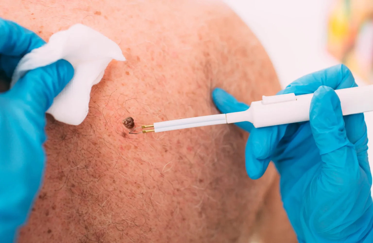 Techniques in Skin Tag Removal Skin Tag Removal