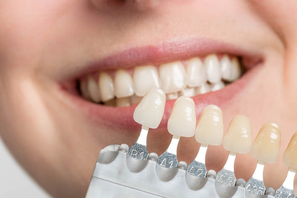 Getting Veneers